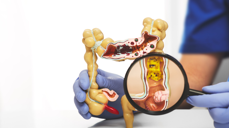 trieu-chung-sau-khi-cat-polyp-dai-trang 1