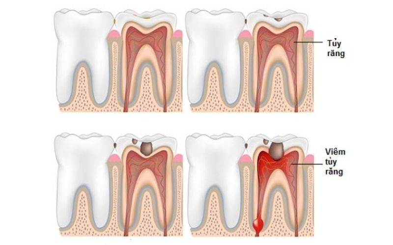 Triệu chứng sau khi lấy tủy răng bất thường cần thận trọng 1