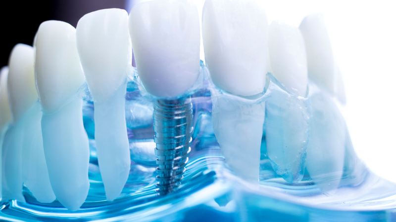 Trồng 4 răng cửa​ liên tiếp nên chọn phương pháp nào? 1
