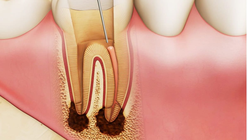 Trồng răng có cần lấy tủy không? 2