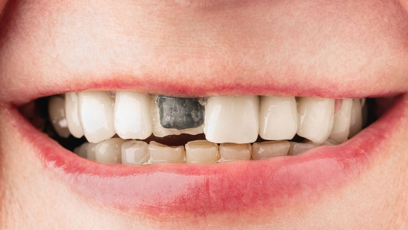 Trồng răng cửa bị gãy​: Có những phương pháp nào? 1