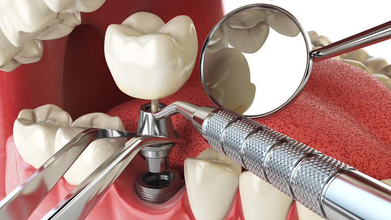 Trồng răng giả​ và những thông tin quan trọng bạn cần biết2