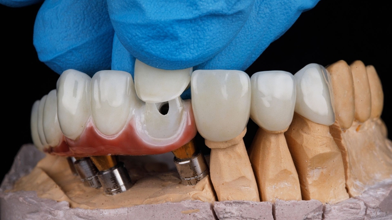 Trồng răng cửa bị gãy​: Có những phương pháp nào? 3
