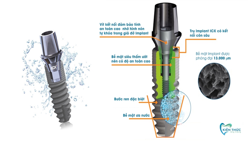 Trụ Implant ICX có tốt không? So sánh trụ Implant ICX với các loại khác 2