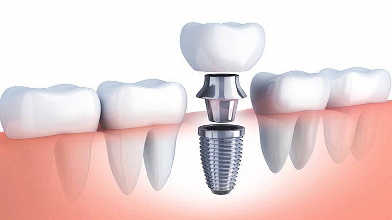 Trụ implant straumann và đặc điểm nổi trội 1