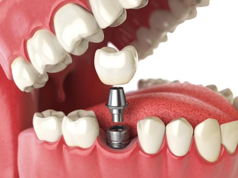 Trụ implant straumann và đặc điểm nổi trội 4