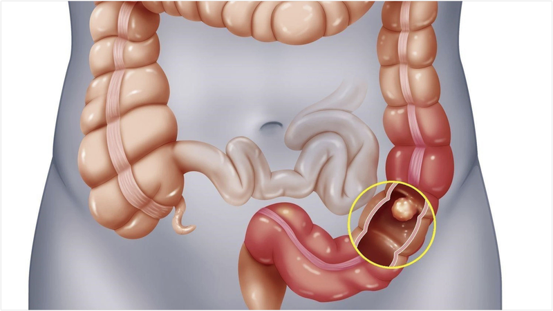 Phân biệt trực tràng và đại tràng 3