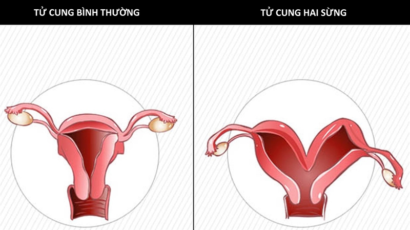 Phụ nữ có tử cung hai sừng liệu có thể sinh con hay không?-1