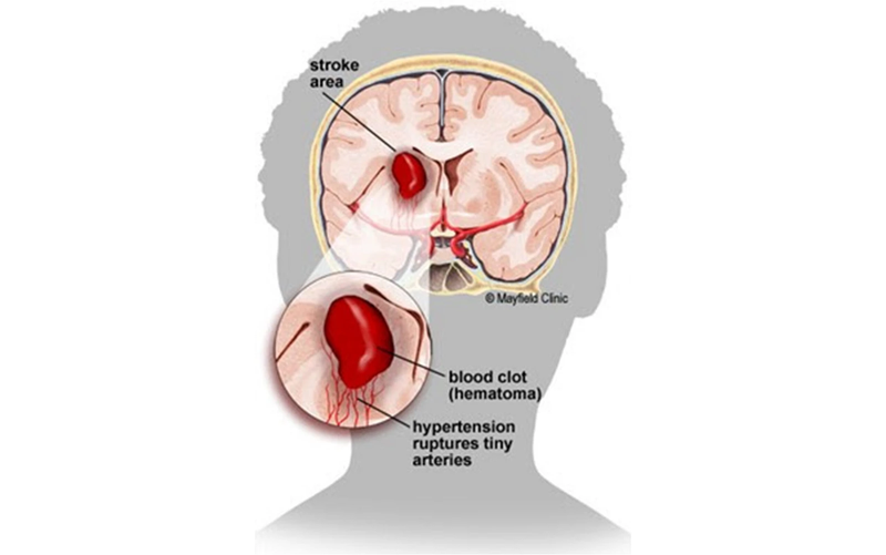 Tụ máu não: Nguyên nhân, dấu hiệu và cách phòng tránh 1