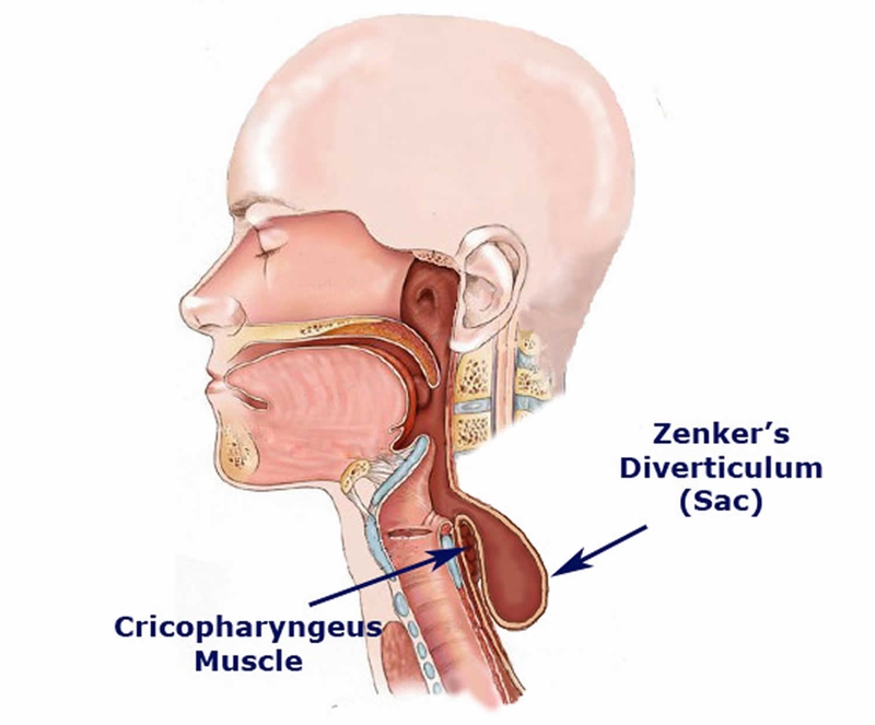 Túi thừa Zenker là gì? Điều trị như thế nào? 1