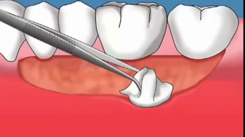 Tụt lợi răng lung lay có mấy mức độ? Cách khắc phục 3