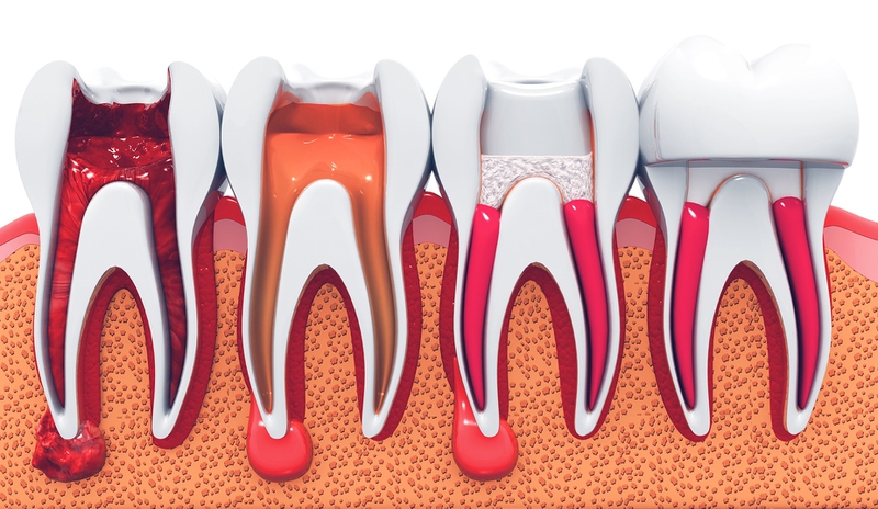 Tủy răng: Cấu tạo, vai trò và bệnh lý thường gặp 1