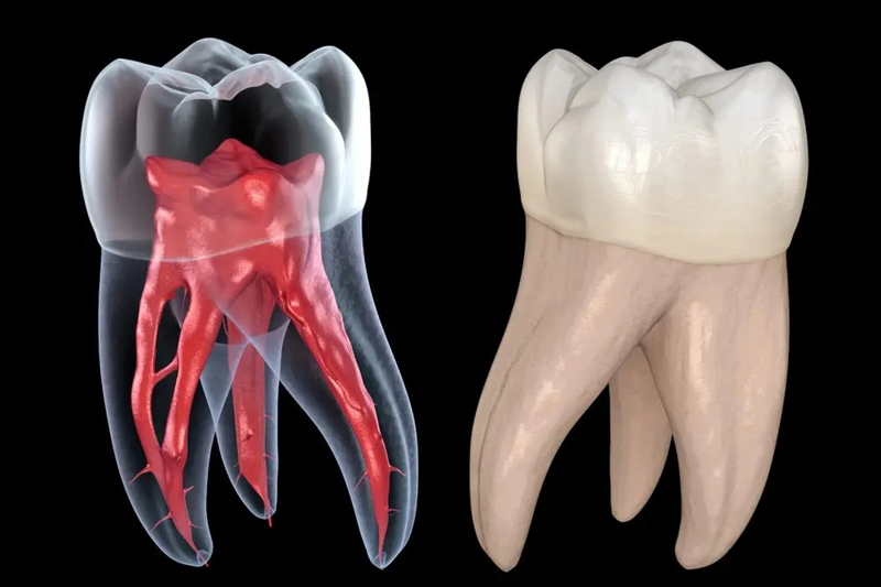 Tủy răng là gì? Tủy răng có quan trọng hay không? Bệnh lý về tủy răng 2