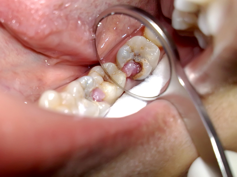 Tủy răng là gì? Tủy răng có quan trọng hay không? Bệnh lý về tủy răng 3
