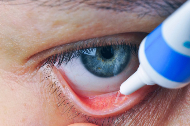 U kết mạc mắt: Nguyên nhân, phân loại, cách điều trị và phòng ngừa bệnh 4