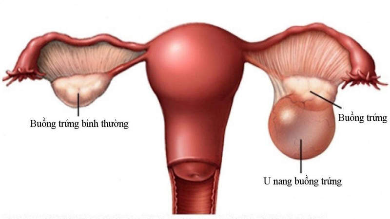 U nang buồng trứng được phân chia thành hai loại chính là u nang thực thể và u nang cơ năng