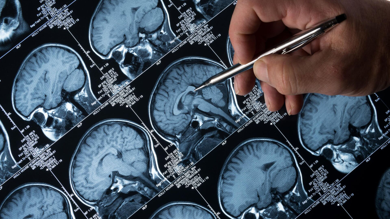 U não nguyên phát là gì? Bệnh u não nguyên phát có biến chứng nguy hiểm không? 5