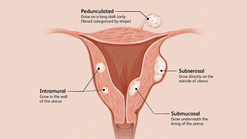 U xơ tử cung dưới niêm mạc nguy hiểm như thế nào? Có chữa được không? 1