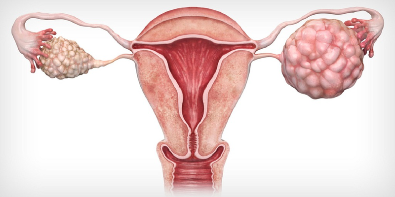 Ung thư buồng trứng giai đoạn 3: Phương pháp điều trị và tiên lượng 1