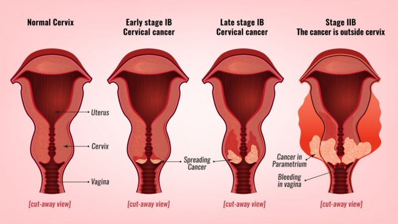 Ung thư cổ tử cung có nguy hiểm không? Các giai đoạn và cách phòng ngừa bệnh 1
