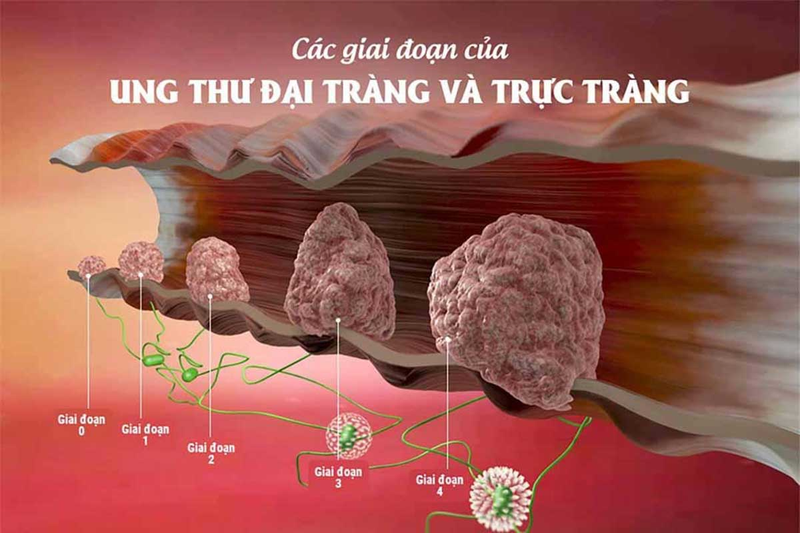 Ung thư đại trực tràng có chữa khỏi được không?