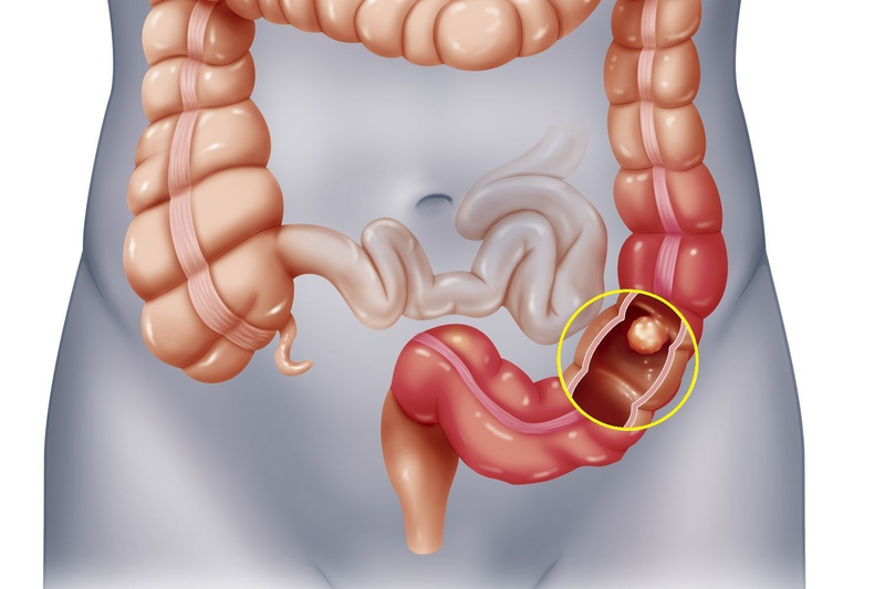 Ung thư đại trực tràng có chữa khỏi được không?