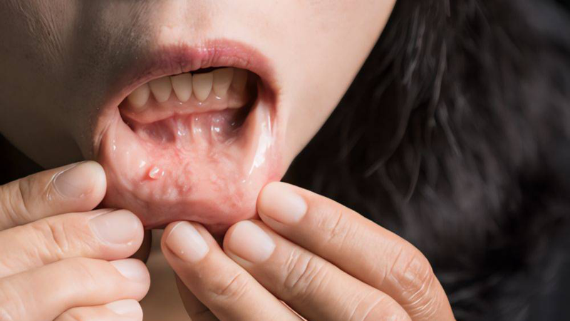 Bị ung thư khoang miệng sống được bao lâu phụ thuộc vào thời điểm phát hiện bệnh