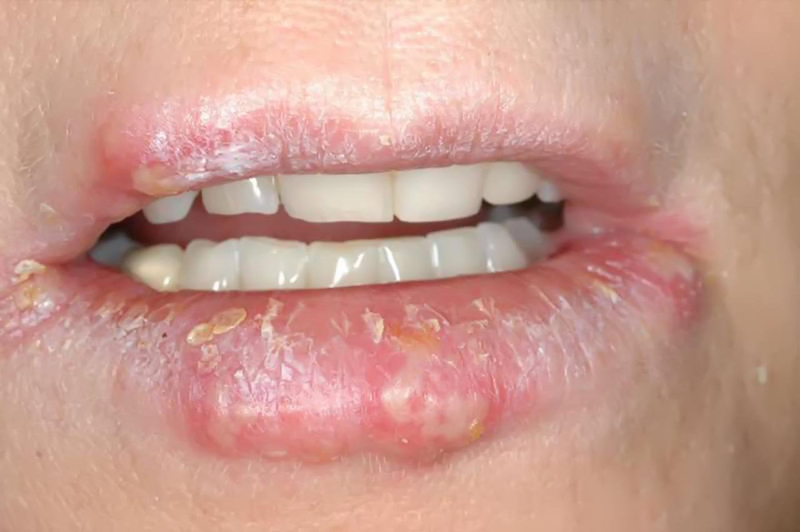 Ung thư môi: Nguyên nhân, triệu chứng và phương pháp điều trị 4