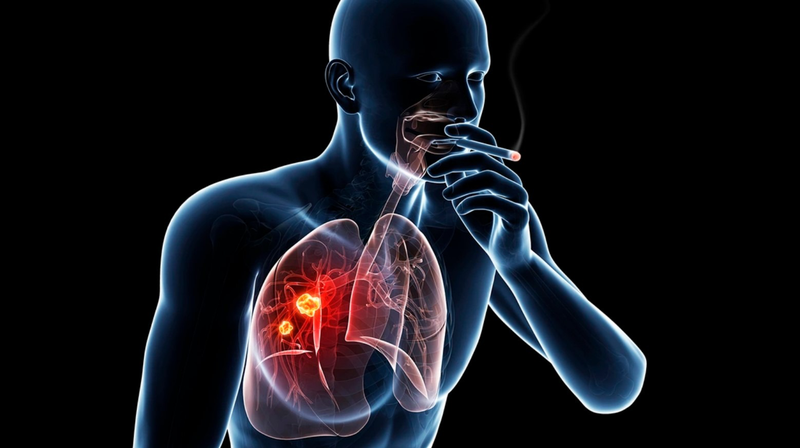 Ung thư phổi không tế bào nhỏ giai đoạn II: Hiểu rõ để điều trị tốt hơn 5