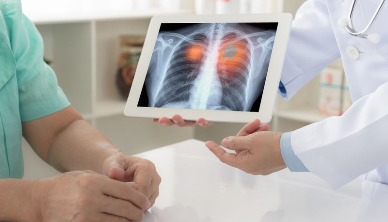 Ung thư phổi tế bào nhỏ giai đoạn lan tràn và những điều cần biết 1