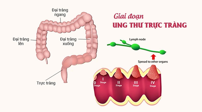 Ung thư trực tràng giai đoạn 4 là gì? Những vấn đề cần biết về Ung thư trực tràng giai đoạn 4-1.jpg