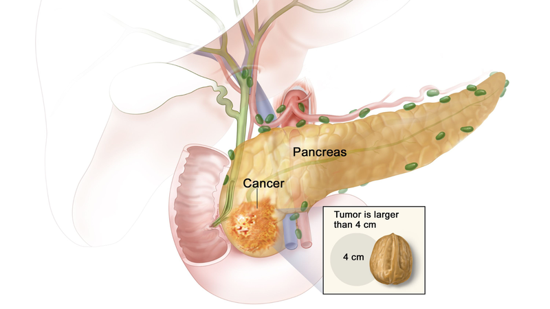 Ung thư tụy: Dấu hiệu nhận biết và phương pháp điều trị 1
