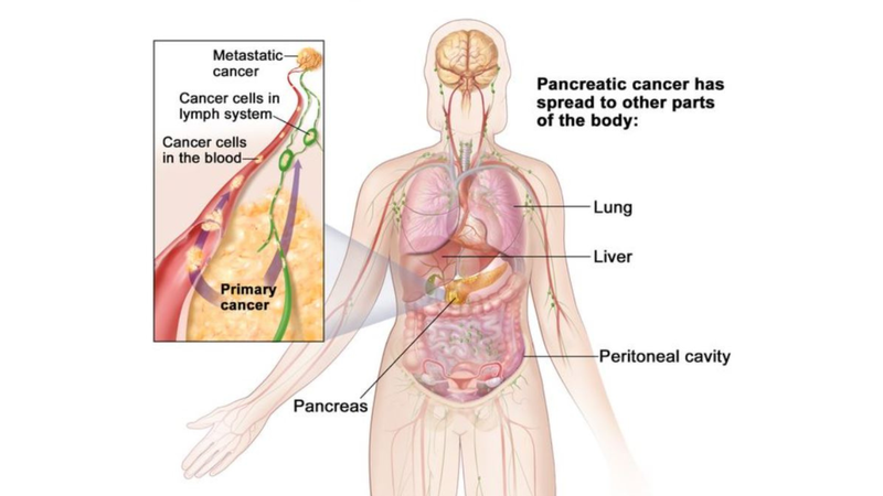 Ung thư tụy: Dấu hiệu nhận biết và phương pháp điều trị 3
