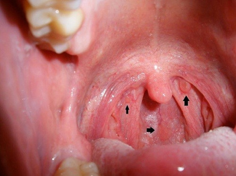 Ung thư vòm họng và những hình ảnh ung thư vòm họng giai đoạn đầu 1