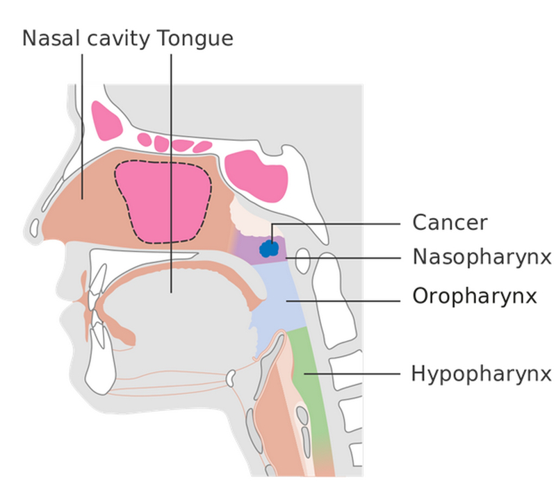Ung thư vòm họng và những hình ảnh ung thư vòm họng giai đoạn đầu 3