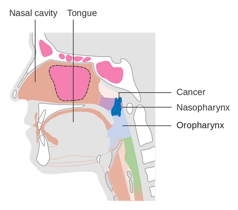 Ung thư vòm họng và những hình ảnh ung thư vòm họng giai đoạn đầu 4