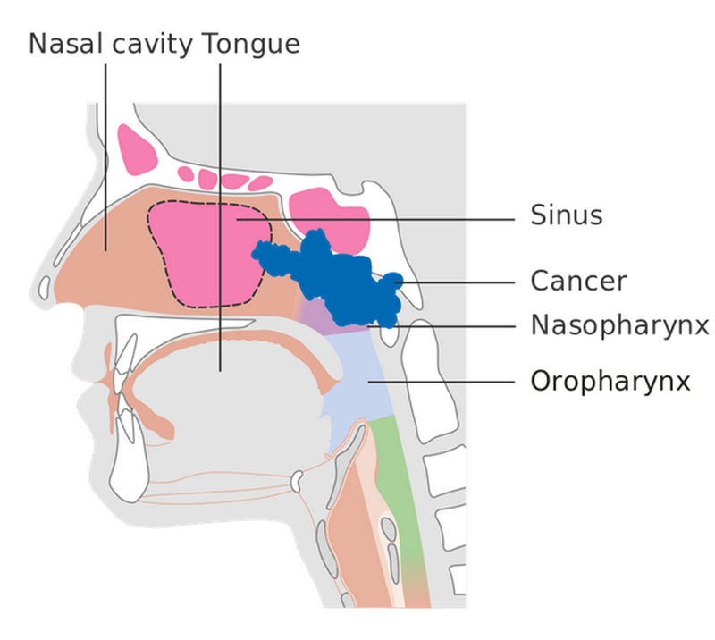 Ung thư vòm họng và những hình ảnh ung thư vòm họng giai đoạn đầu 5