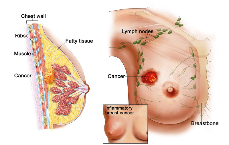 Ung thư vú có nên mổ không? Phương pháp điều trị ung thư vú như thế nào? 1