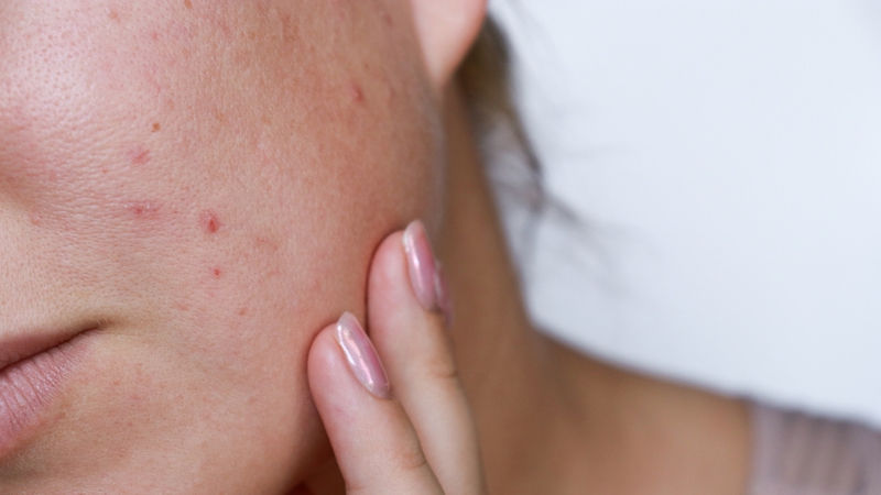 Uống collagen có bị nổi mụn không là thắc mắc của nhiều người