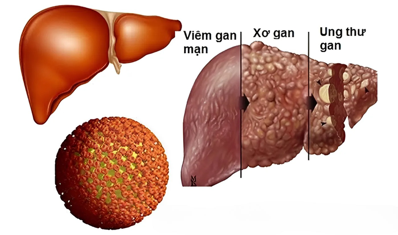 Vắcxin TherVacB điều trị viêm gan B mãn tính bước vào thử nghiệm lâm sàng