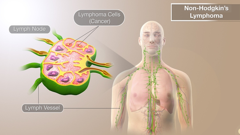 Vai trò, cấu trúc của hạch bạch huyết trong cơ thể và các bệnh thường gặp 1