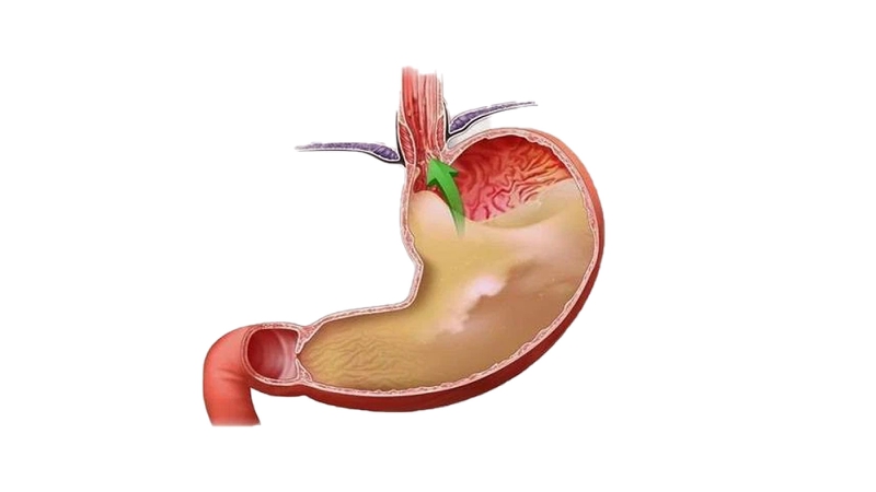 Van dạ dày thực quản là gì? Cấu tạo và chức năng của van 1