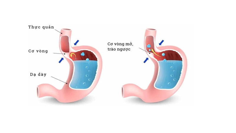 Van dạ dày thực quản là gì? Cấu tạo và chức năng của van 2