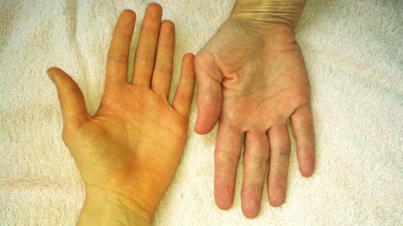 Vàng da lòng bàn tay có phải mắc bệnh không 3