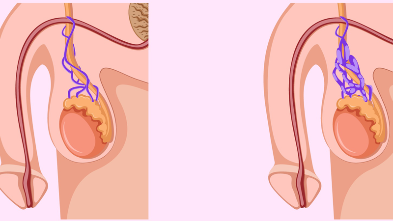 Giãn tĩnh mạch thừng tinh là gì? 1