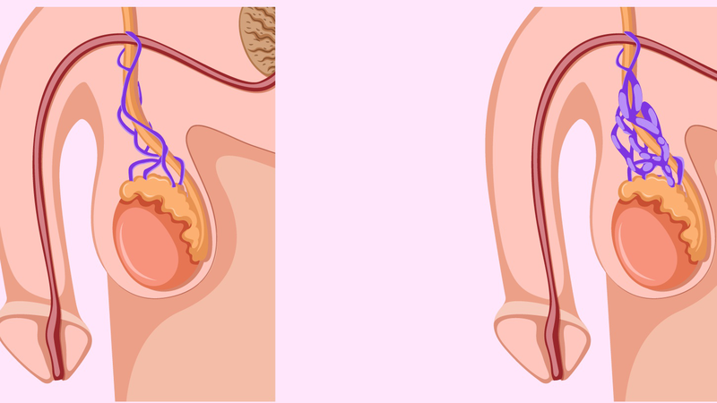 Giãn tĩnh mạch thừng tinh là gì? 3