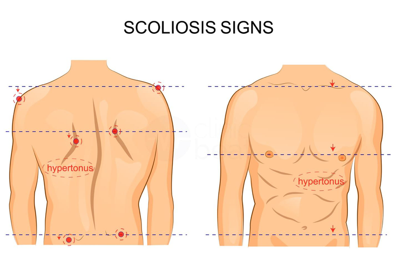 Vẹo cột sống tự phát là gì? Những vấn đề cần biết về vẹo cột sống tự phát 1