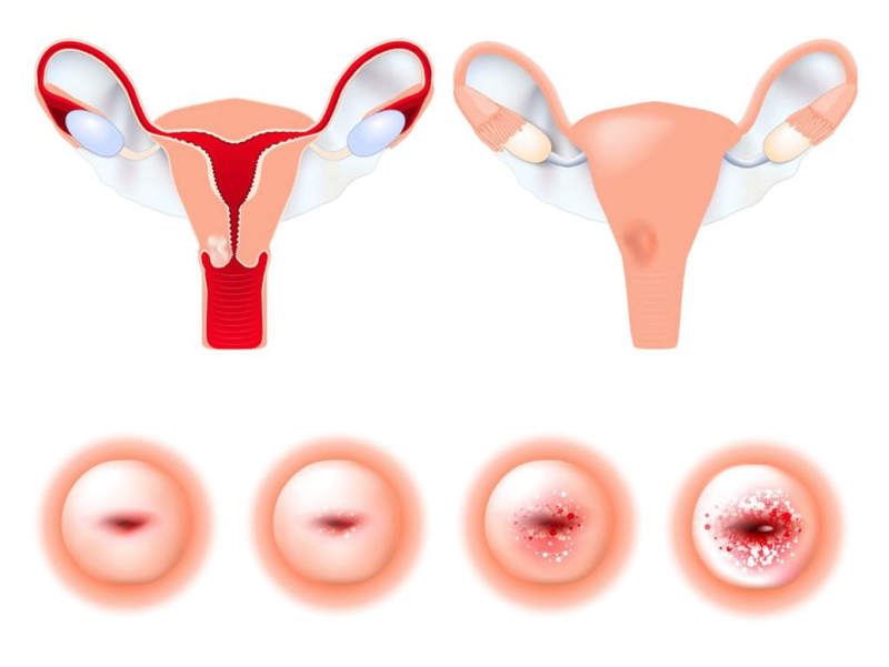 Vết trắng cổ tử cung: Cơ chế bệnh, phân loại tổn thương và cách xử trí chị em nên biết 1