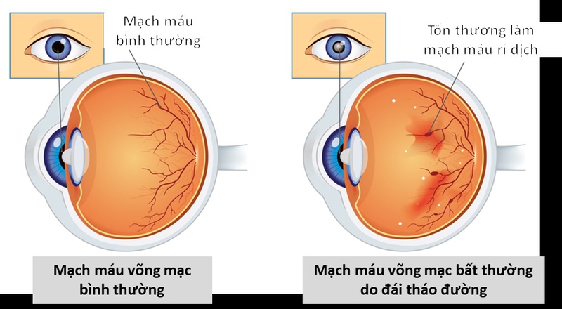 Vì sao cần quan tâm hơn đến bệnh võng mạc đái tháo đường?1