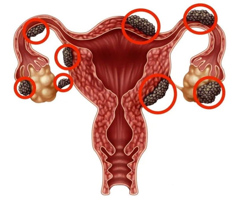 Vì sao lạc nội mạc tử cung gây vô sinh? 1